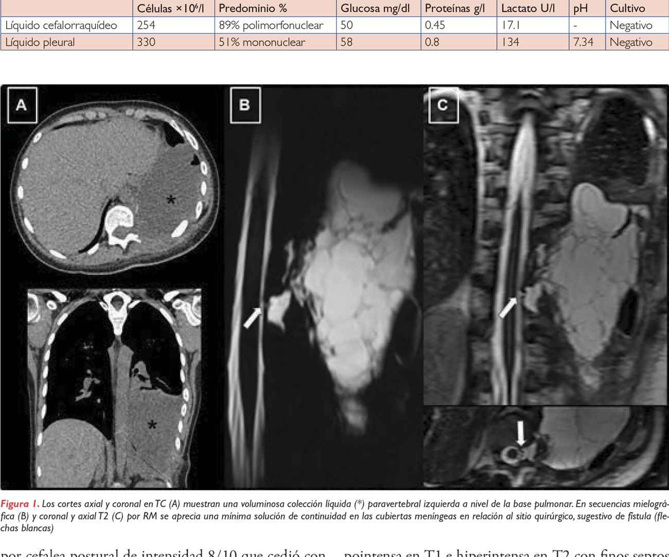 Fístula subaracnoidea pleural secundaria a resección de ganglioneuroblastoma paravertebral izquierdo toracoretroperitoneal: reporte de un caso