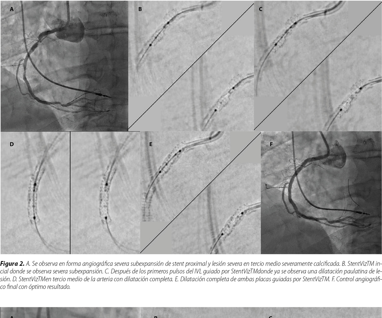 Litotricia intracoronaria para la resolución de la subexpansión del stent: utilidad del uso de realce de la visualización del stent o StentViz™