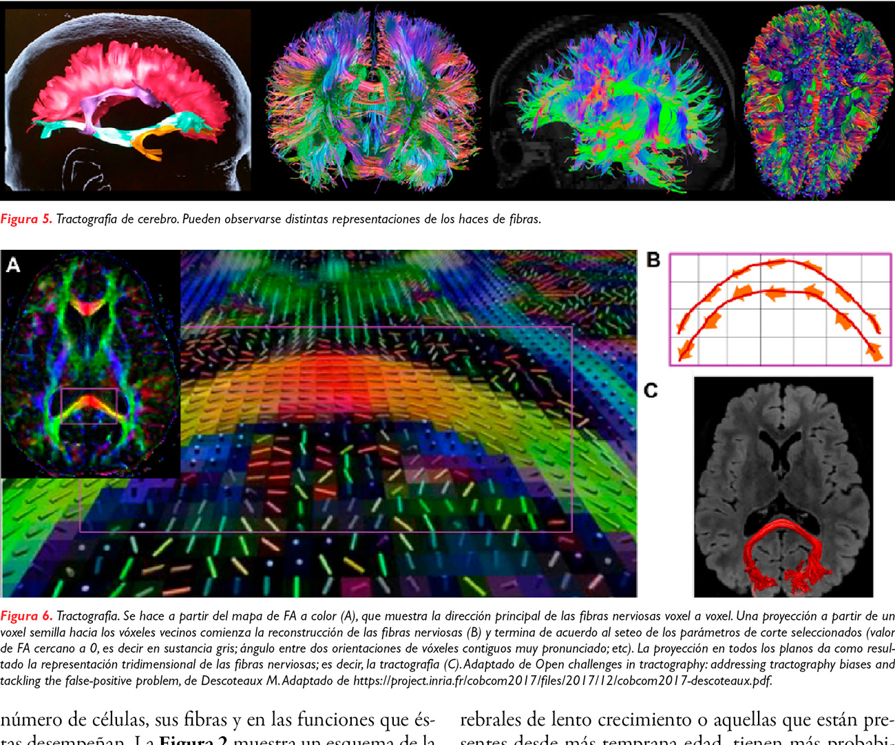 Utilidad de la resonancia magnética funcional y tractografía en la planificación y resección quirúrgica de lesiones cerebrales