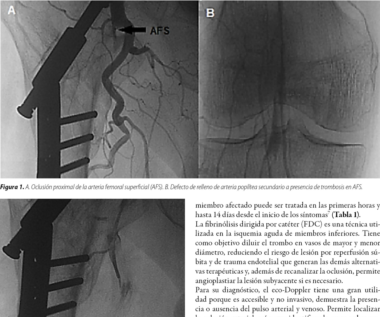 Oclusión aguda de arteria femoral superficial. Resolución endovascular farmacoinvasiva intratrombo