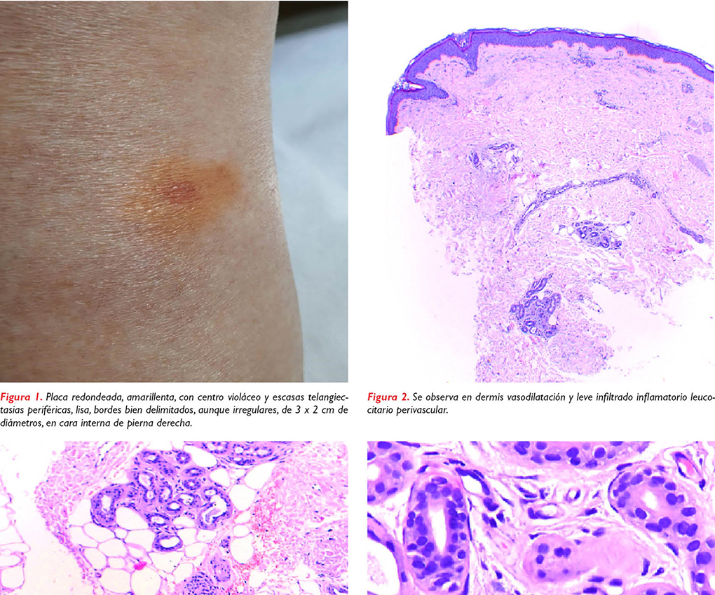 Amiloidosis cutánea nodular: presentación  de un caso