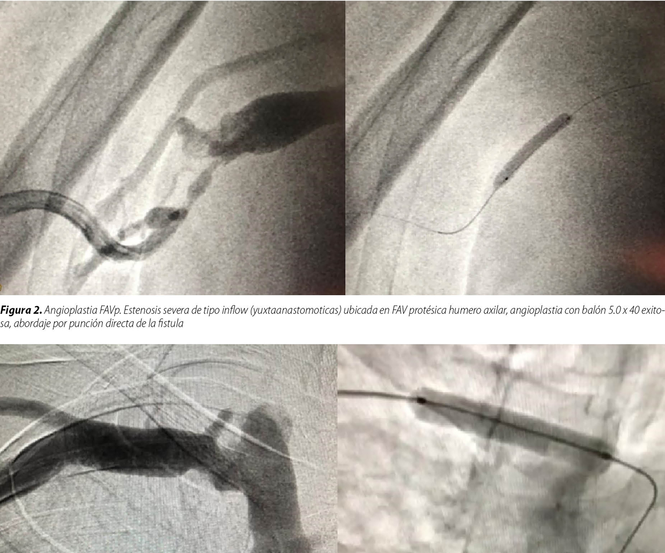 Complicaciones estenóticas de fístulas arteriovenosas y su resolución mediante angioplastia percutánea