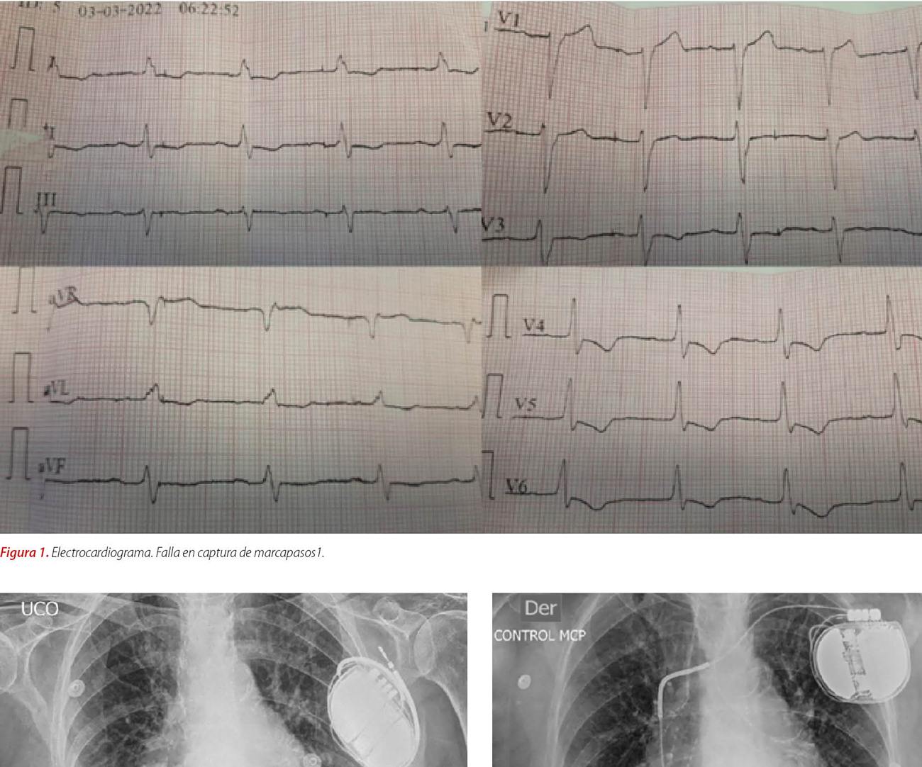 Síndrome de reel en un paciente portador de cardiodesfibrilador automático implantable