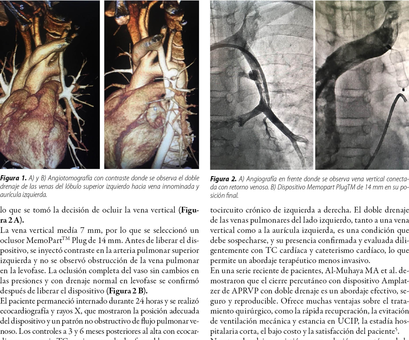 Resolución percutánea de anomalía parcial del retorno venoso pulmonar izquierdo con doble drenaje  en paciente pediátrico. Reporte de caso