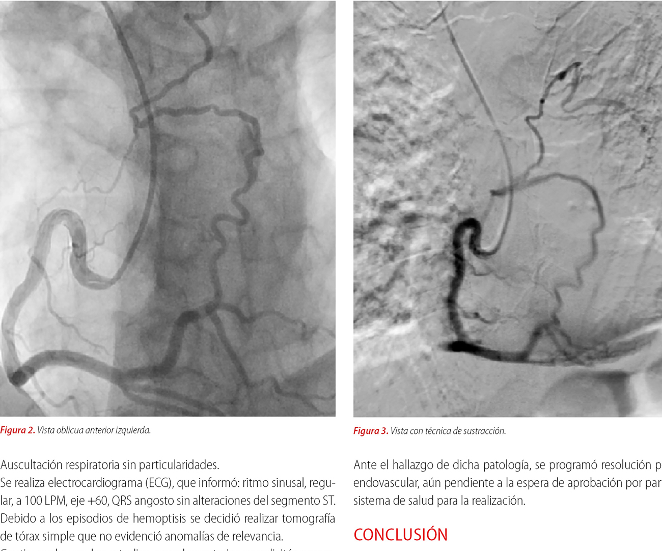 Fístula entre arteria coronaria derecha y vasculatura pulmonar
