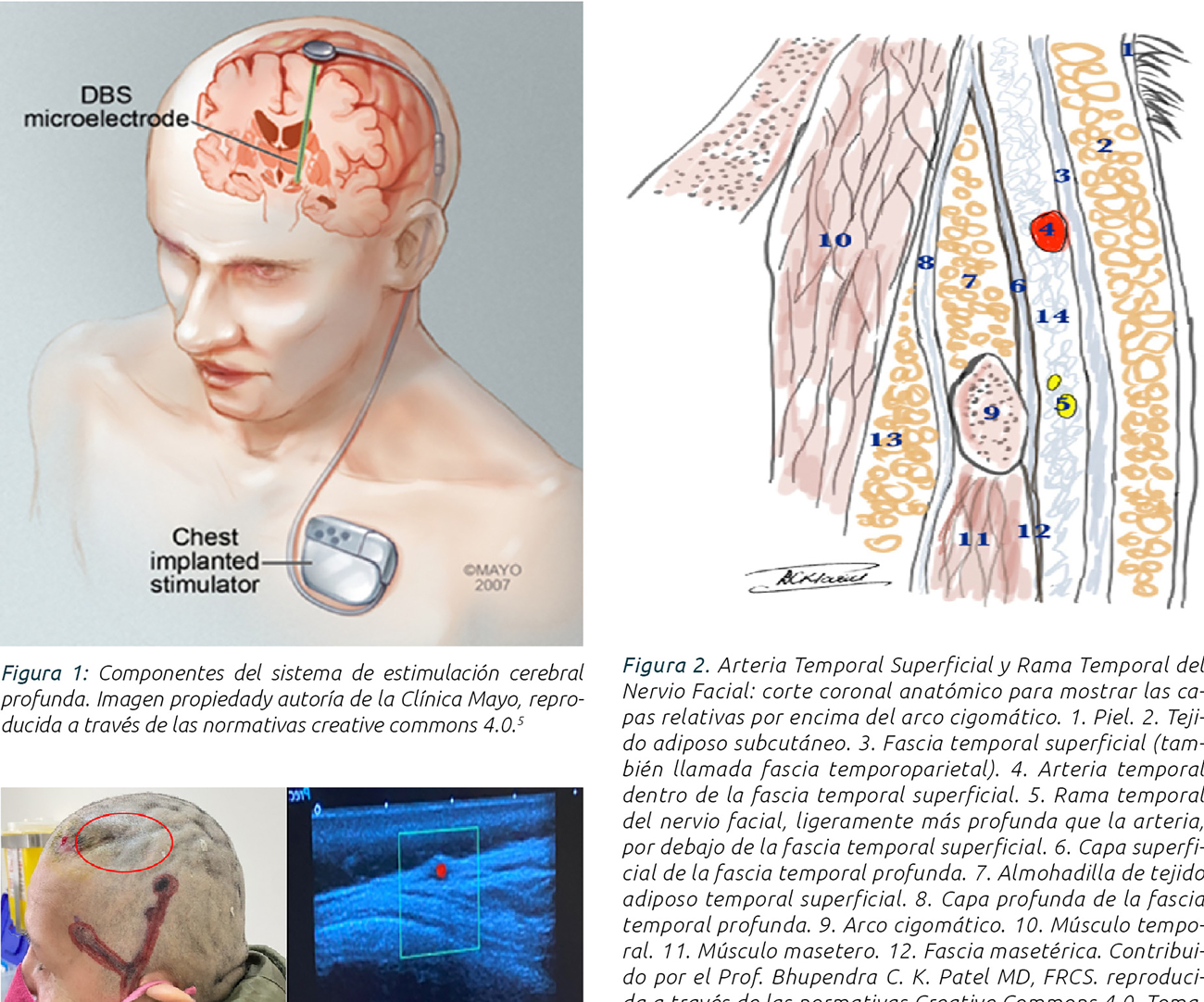 Colgajo axial de fascia temporoparietal (TPFF) para cobertura de dispositivo de estimulaciÃ³n cerebral profunda. Reporte de caso