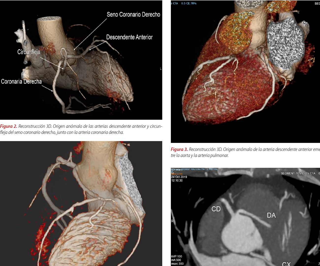 Utilidad clínica de la angiotomografía coronaria en el diagnóstico de las anomalías coronarias congénitas
