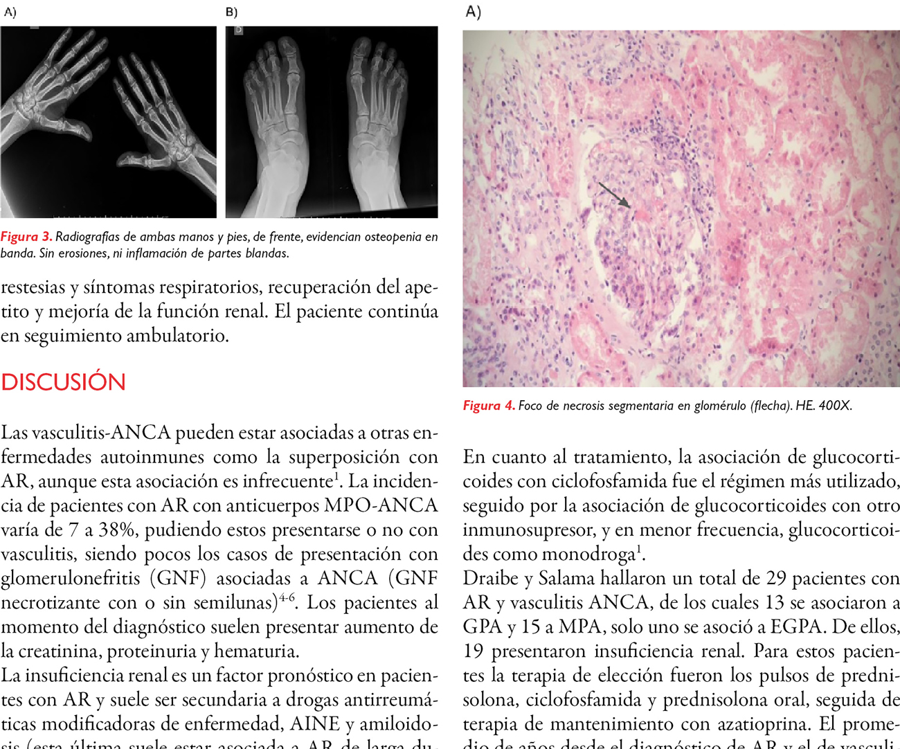 Vasculitis ANCA y artritis reumatoide como presentación contemporánea